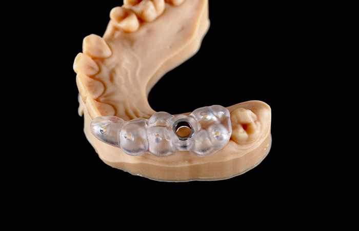 サージカルガイドを用いた的確かつ迅速な治療