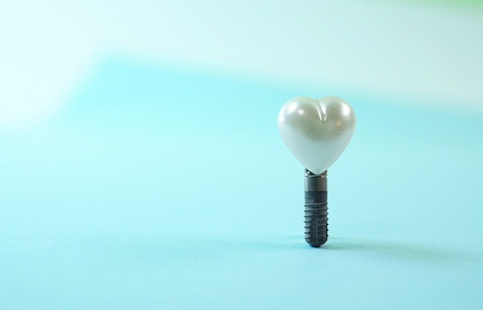 インプラントのメリット