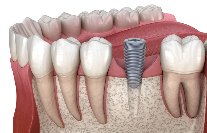 人工歯根を埋め込む外科手術